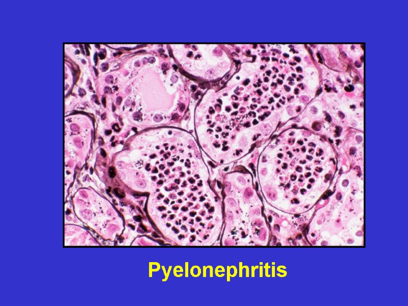 Pyelonephritis